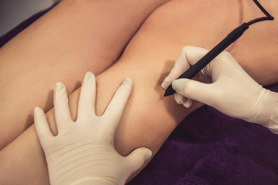 Body Hair Removal